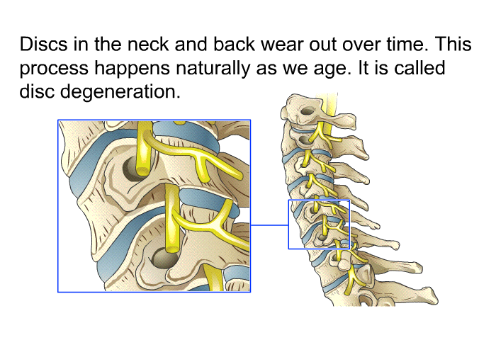 Discs in the neck and back wear out over time. This process happens naturally as we age. It is called disc degeneration.