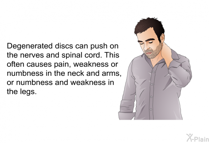 Degenerated discs can push on the nerves and spinal cord. This often causes pain, weakness or numbness in the neck and arms, or numbness and weakness in the legs.