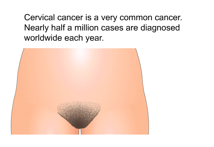 Cervical cancer is a very common cancer. Nearly half a million cases are diagnosed worldwide each year.