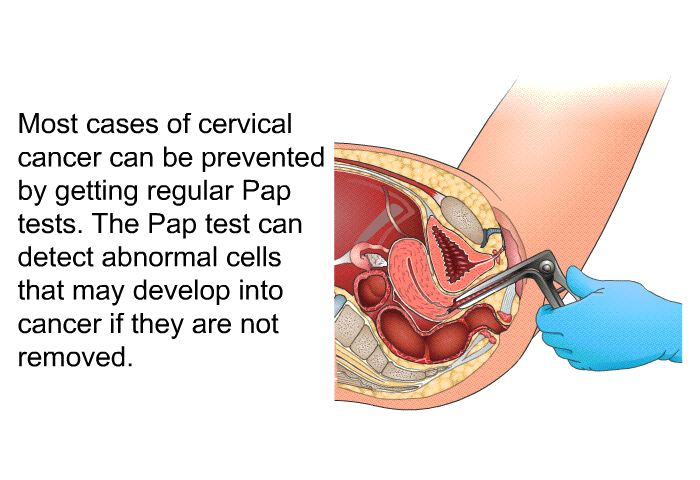 Most cases of cervical cancer can be prevented by getting regular Pap tests. The Pap test can detect abnormal cells that may develop into cancer if they are not removed.
