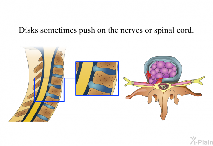 Disks sometimes push on the nerves or spinal cord.