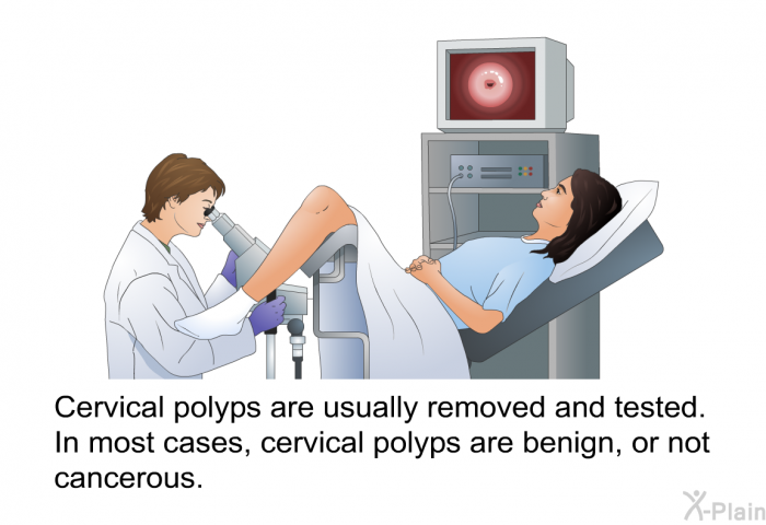 Cervical polyps are usually removed and tested. In most cases, cervical polyps are benign, or not cancerous.
