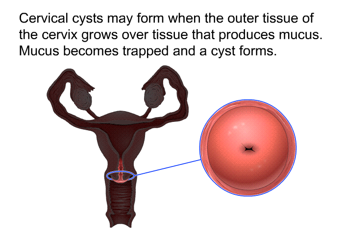 Cervical cysts may form when the outer tissue of the cervix grows over tissue that produces mucus. Mucus becomes trapped and a cyst forms.