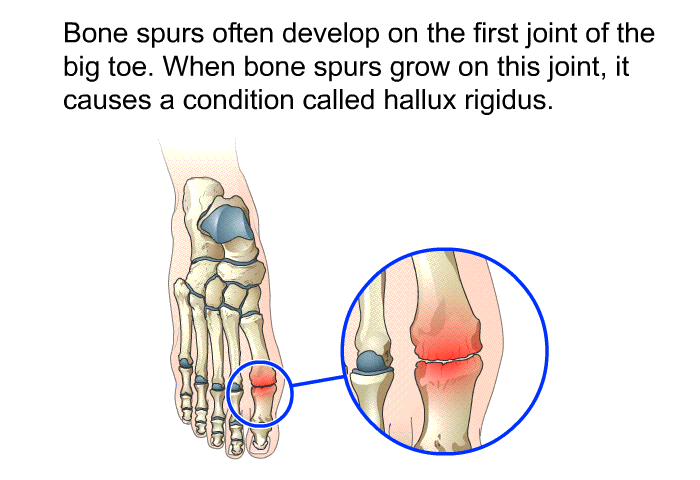 Bone spurs often develop on the first joint of the big toe. When bone spurs grow on this joint, it causes a condition called hallux rigidus.