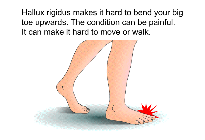 Hallux rigidus makes it hard to bend your big toe upwards. The condition can be painful. It can make it hard to move or walk.