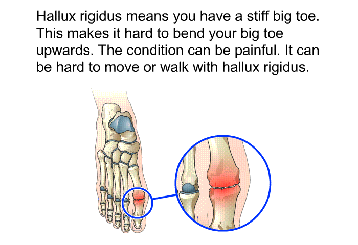 Hallux rigidus means you have a stiff big toe. This makes it hard to bend your big toe upwards. The condition can be painful. It can be hard to move or walk with hallux rigidus.