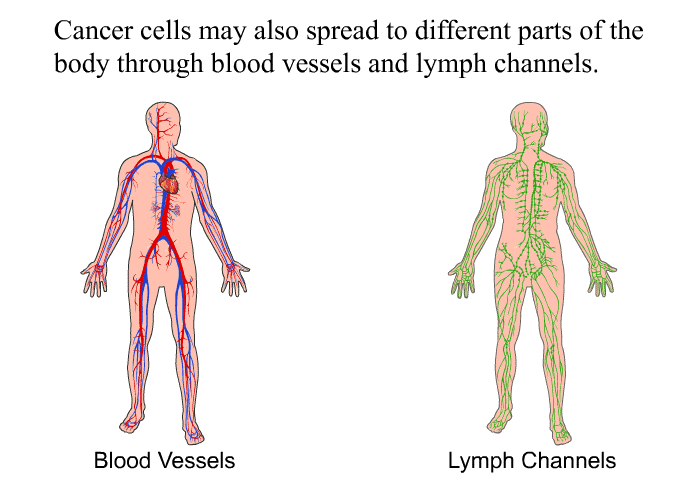 Cancer cells may also spread to different parts of the body through blood vessels and lymph channels.