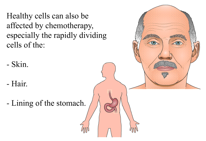 Healthy cells can also be affected by chemotherapy, especially the rapidly dividing cells of the:  Skin. Hair. Lining of the stomach.