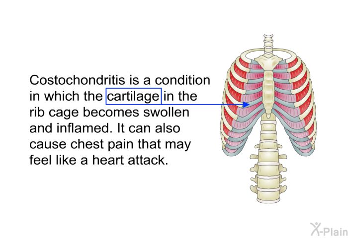 Costochondritis is a condition in which the cartilage in the rib cage becomes swollen and inflamed. It can also cause chest pain that may feel like a heart attack.