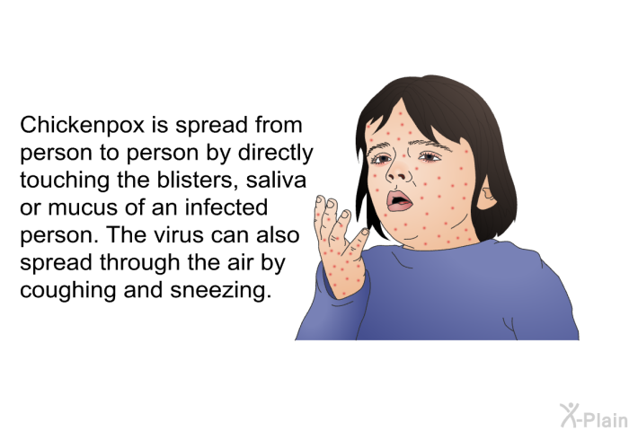 Chickenpox is spread from person to person by directly touching the blisters, saliva or mucus of an infected person. The virus can also spread through the air by coughing and sneezing.