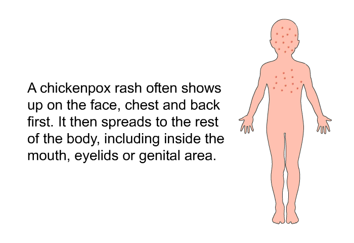 A chickenpox rash often shows up on the face, chest and back first. It then spreads to the rest of the body, including inside the mouth, eyelids or genital area.