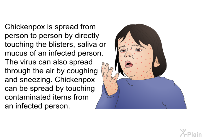 Chickenpox is spread from person to person by directly touching the blisters, saliva or mucus of an infected person. The virus can also spread through the air by coughing and sneezing. Chickenpox can be spread by touching contaminated items from an infected person.