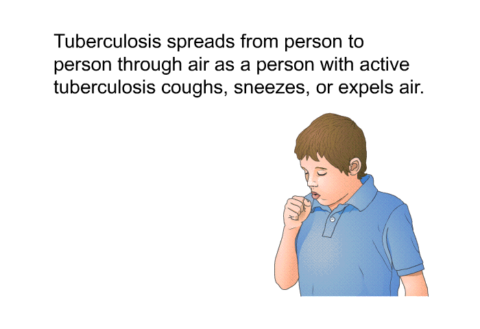 Tuberculosis spreads from person to person through air as a person with active tuberculosis coughs, sneezes, or expels air.