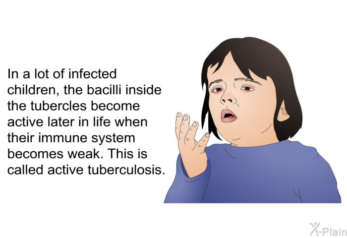 In a lot of infected children, the bacilli inside the tubercles become active later in life when their immune system becomes weak. This is called active tuberculosis.