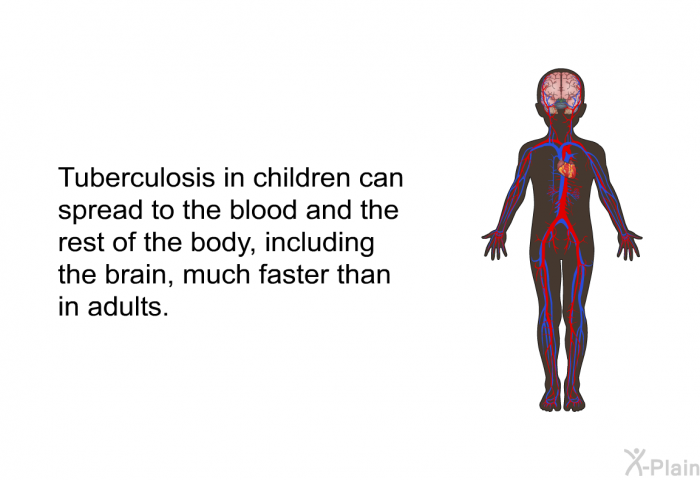 Tuberculosis in children can spread to the blood and the rest of the body, including the brain, much faster than in adults.
