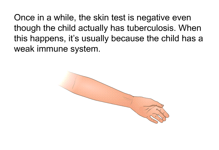 Once in a while, the skin test is negative even though the child actually has tuberculosis. When this happens, it's usually because the child has a weak immune system.