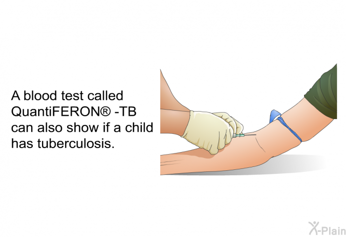A blood test called QuantiFERON  -TB can also show if a child has tuberculosis.