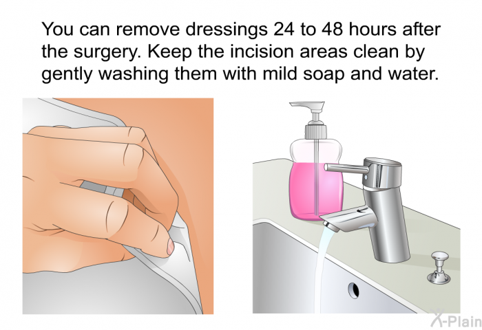 You can remove dressings 24 to 48 hours after the surgery. Keep the incision areas clean by gently washing them with mild soap and water.