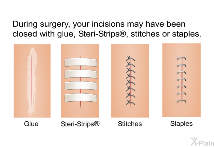 During surgery, your incisions may have been closed with glue, Steri-Strips , stitches or staples.