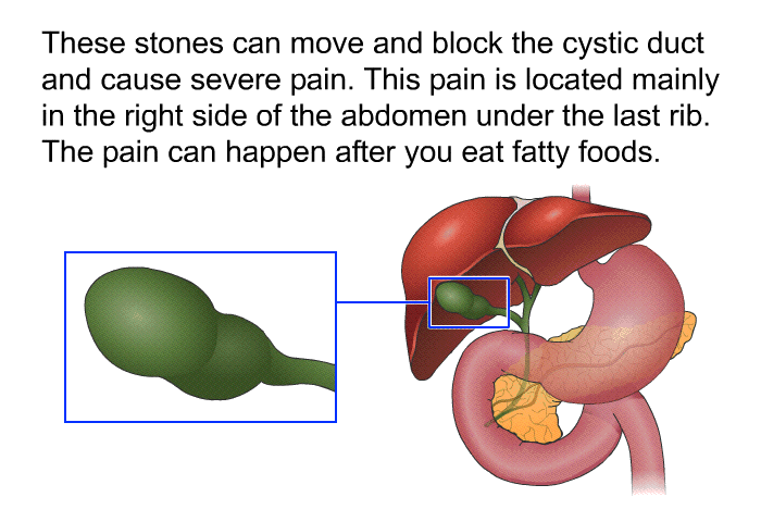 These stones can move and block the cystic duct and cause severe pain. This pain is located mainly in the right side of the abdomen under the last rib. The pain can happen after you eat fatty foods.