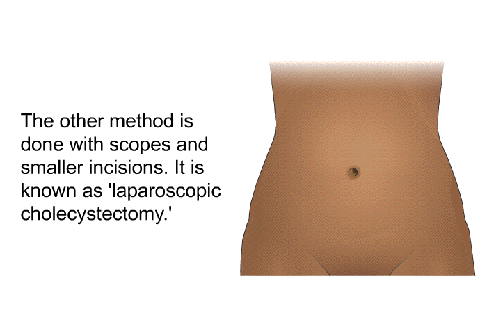 The other method is done with scopes and smaller incisions. It is known as laparoscopic cholecystectomy.