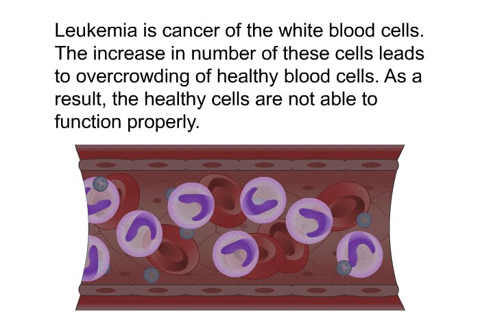 Leukemia is cancer of the white blood cells. The increase in number of these cells leads to overcrowding of healthy blood cells. As a result, the healthy cells are not able to function properly.