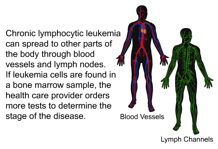 Chronic lymphocytic leukemia can spread to other parts of the body through blood vessels and lymph nodes. If leukemia cells are found in a bone marrow sample, the health care provider orders more tests to determine the stage of the disease.