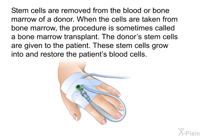 Stem cells are removed from the blood or bone marrow of a donor. When the cells are taken from bone marrow, the procedure is sometimes called a bone marrow transplant. The donor's stem cells are given to the patient. These stem cells grow into and restore the patient's blood cells.
