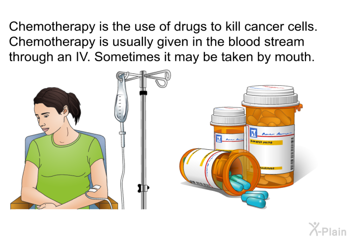 Chemotherapy is the use of drugs to kill cancer cells. Chemotherapy is usually given in the blood stream through an IV. Sometimes it may be taken by mouth.