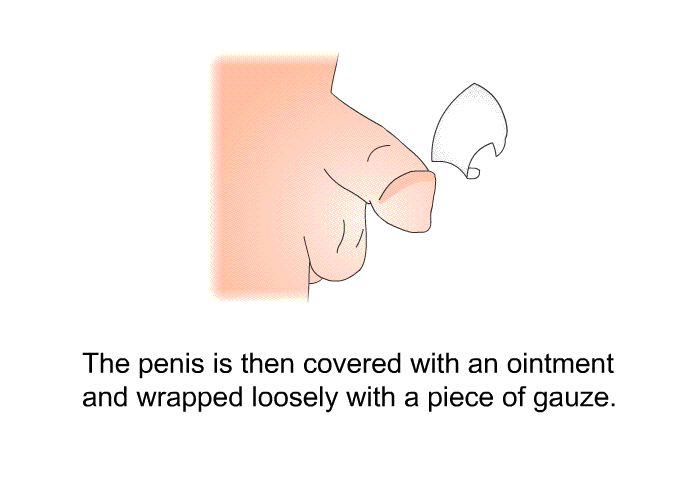 The penis is then covered with an ointment and wrapped loosely with a piece of gauze.