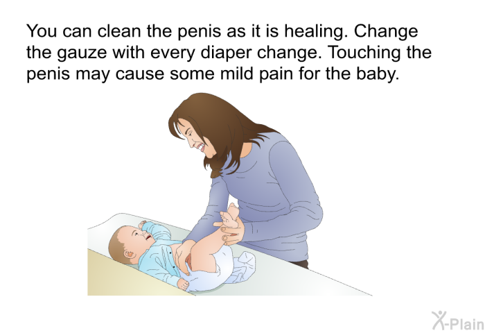 You can clean the penis as it is healing. Change the gauze with every diaper change. Touching the penis may cause some mild pain for the baby.