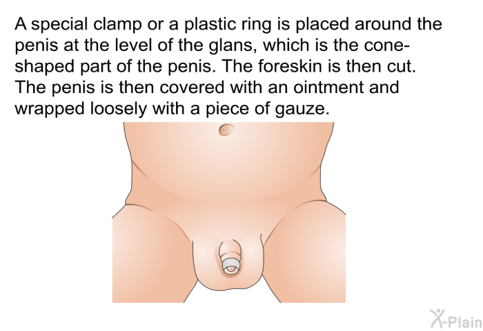 A special clamp or a plastic ring is placed around the penis at the level of the glans, which is the cone-shaped part of the penis. The foreskin is then cut. The penis is then covered with an ointment and wrapped loosely with a piece of gauze.