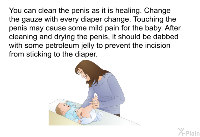 You can clean the penis as it is healing. Change the gauze with every diaper change. Touching the penis may cause some mild pain for the baby. After cleaning and drying the penis, it should be dabbed with some petroleum jelly to prevent the incision from sticking to the diaper.