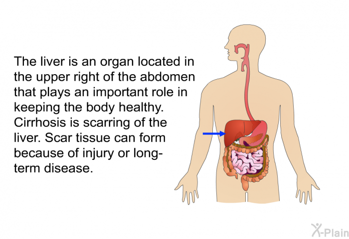 The liver is an organ located in the upper right of the abdomen that plays an important role in keeping the body healthy. Cirrhosis is scarring of the liver. Scar tissue can form because of injury or long-term disease.