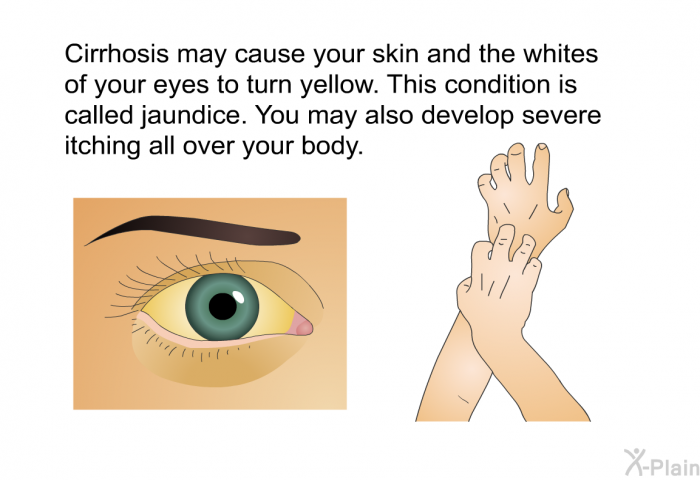 Cirrhosis may cause your skin and the whites of your eyes to turn yellow. This condition is called jaundice. You may also develop severe itching all over your body.