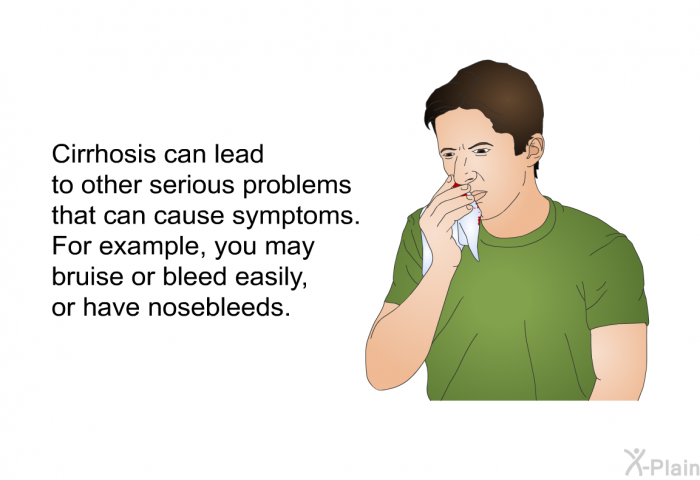 Cirrhosis can lead to other serious problems that can cause symptoms. For example, you may bruise or bleed easily, or have nosebleeds.