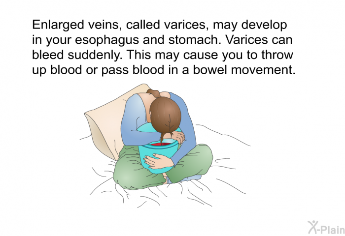 Enlarged veins, called varices, may develop in your esophagus and stomach. Varices can bleed suddenly. This may cause you to throw up blood or pass blood in a bowel movement.