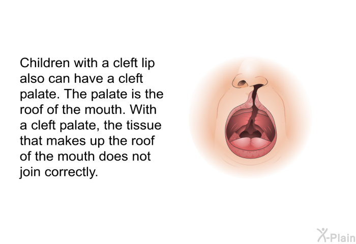 Children with a cleft lip also can have a cleft palate. The palate is the roof of the mouth. With a cleft palate, the tissue that makes up the roof of the mouth does not join correctly.