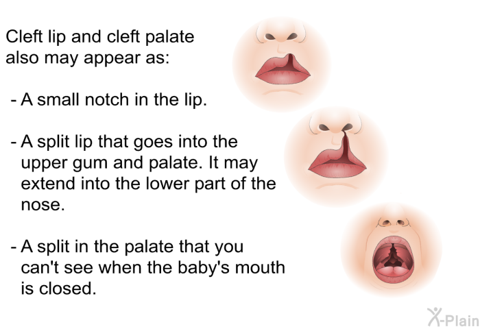 Cleft lip and cleft palate also may appear as:  A small notch in the lip. A split lip that goes into the upper gum and palate. It may extend into the lower part of the nose. A split in the palate that you can't see when the baby's mouth is closed.