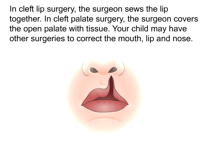 In cleft lip surgery, the surgeon sews the lip together. In cleft palate surgery, the surgeon covers the open palate with tissue. Your child may have other surgeries to correct the mouth, lip and nose.