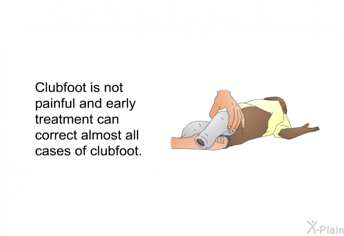 Clubfoot is not painful and early treatment can correct almost all cases of clubfoot.