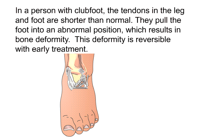 In a person with clubfoot, the tendons in the leg and foot are shorter than normal. They pull the foot into an abnormal position, which results in bone deformity. This deformity is reversible with early treatment.