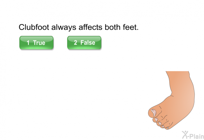 Clubfoot always affects both feet.