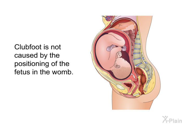 Clubfoot is not caused by the positioning of the fetus in the womb.