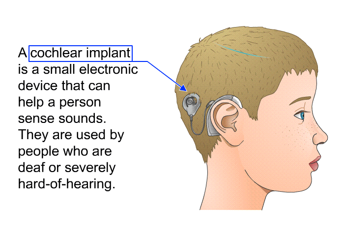 A cochlear implant is a small electronic device that can help a person sense sounds. They are used by people who are deaf or severely hard-of-hearing.