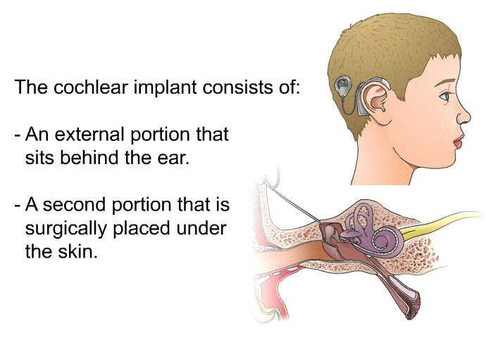 The cochlear implant consists of:  An external portion that sits behind the ear. A second portion that is surgically placed under the skin.