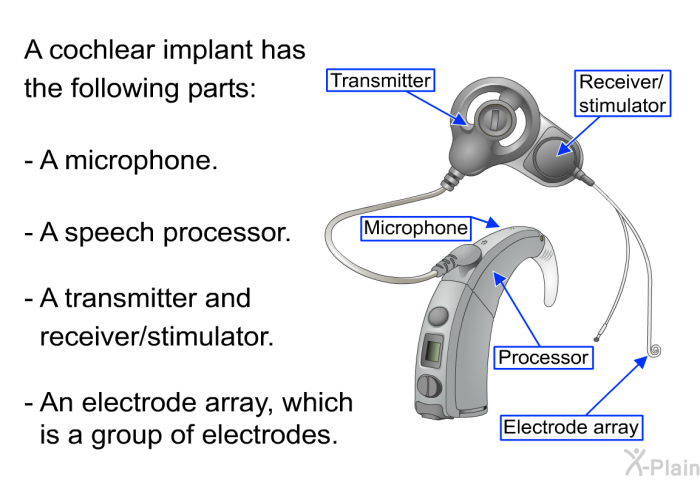 A cochlear implant has the following parts:  A microphone. A speech processor. A transmitter and receiver/stimulator. An electrode array, which is a group of electrodes.