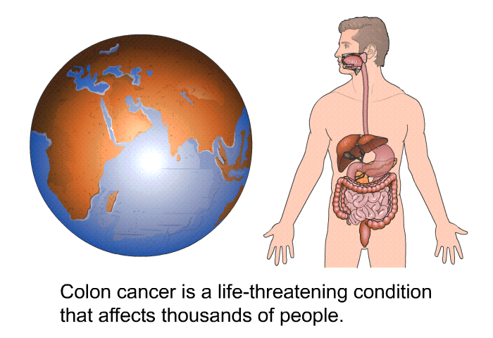 Colon cancer is a life threatening condition that affects thousands of people.