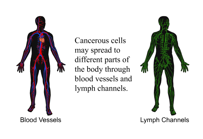 Cancerous cells may spread to different parts of the body through blood vessels and lymph channels.