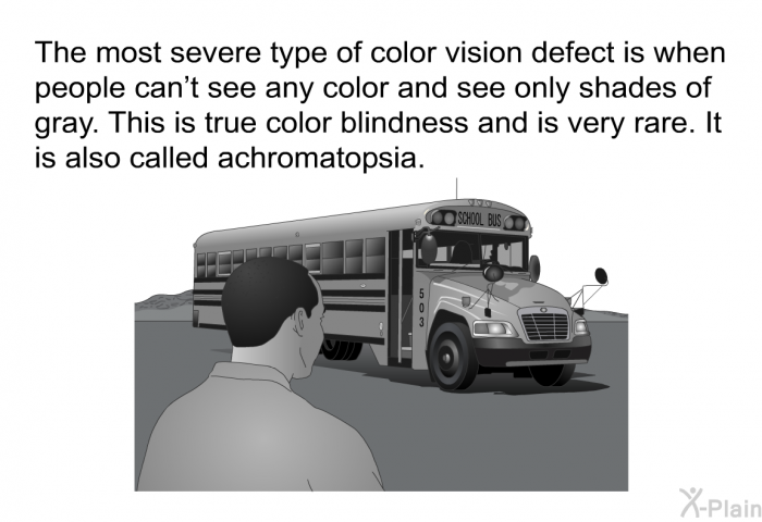 The most severe type of color vision defect is when people can't see any color and see only shades of gray. This is true color blindness and is very rare. It is also called achromatopsia.